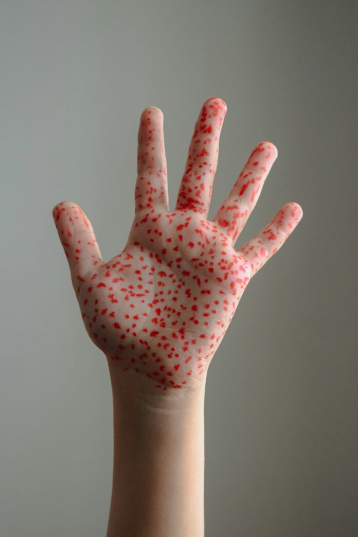 Three Reported Cases Of Measles In LA County