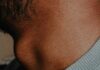 BB Pellet Grazes Neck Of Kyle Franks